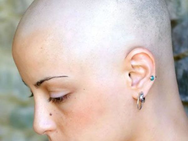 Alopecia Losing your hair doesn't have to be the first thing people notice about you